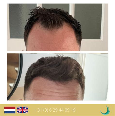 Hoe Voorkom Je Haaruitval Na Een Haartransplantatie?
